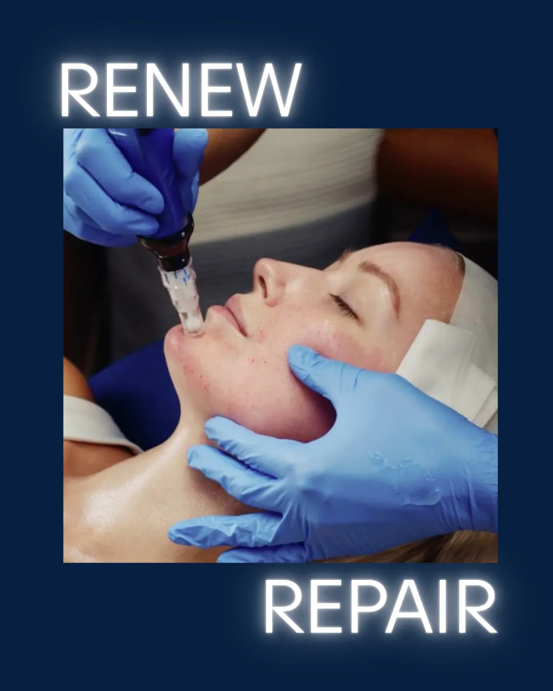 Micro needling treatment for skin renewal and repair at NR Aesthetics & Skin.