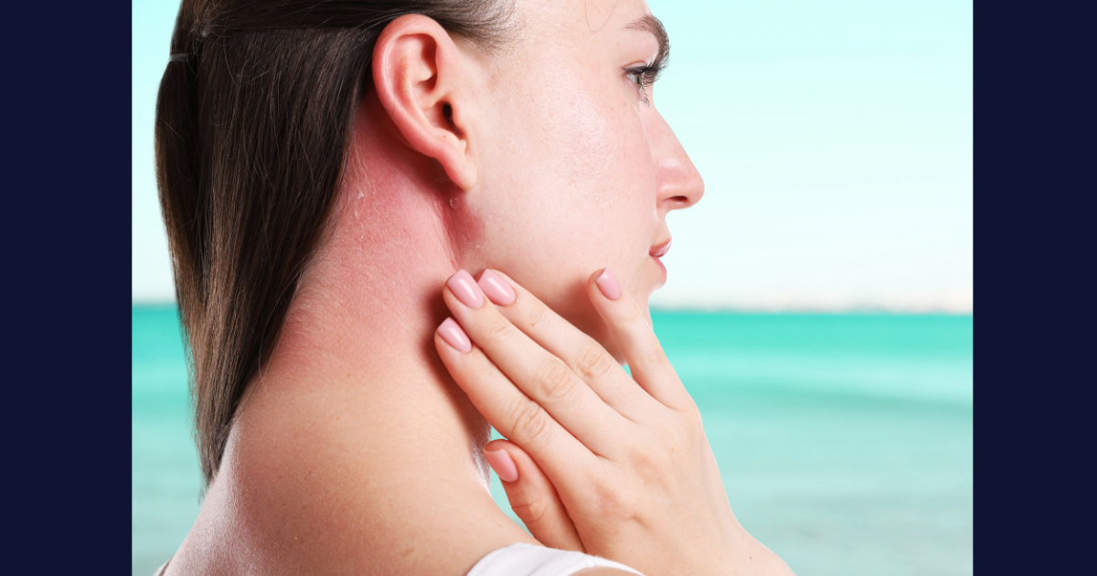 Why SPF Isn’t Optional: Skin Cancer Awareness Month