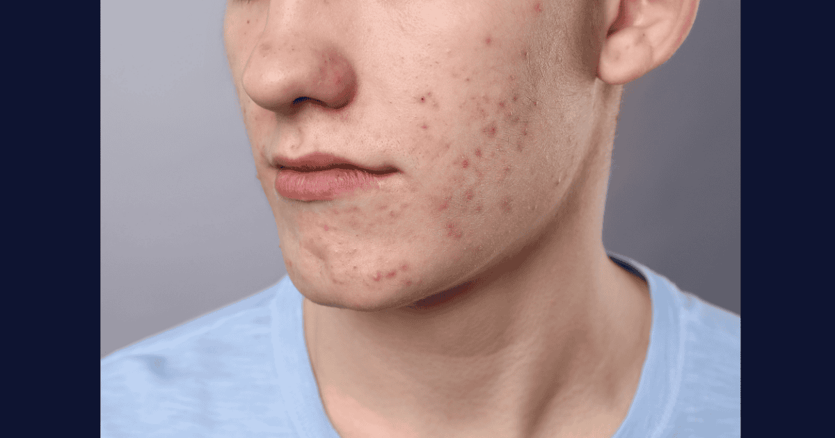 Close-up of teenage male with acne-prone skin, highlighting skin treatment options.
